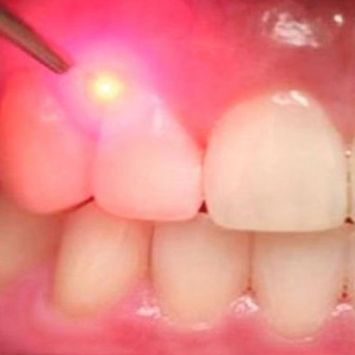 laser-gum-surgery-in-south-delhi-gum-surgery-in-friends-colony-gum