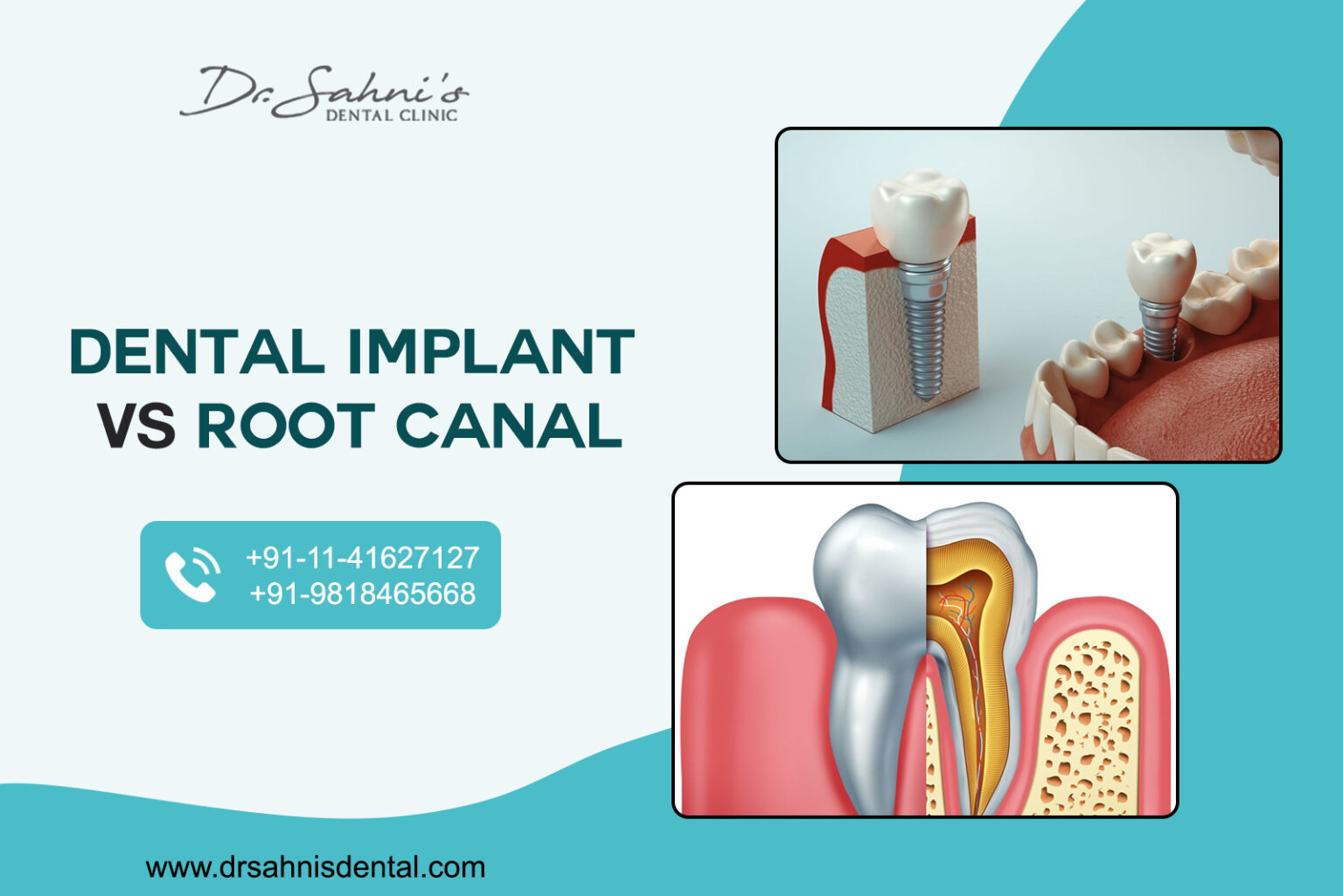 dental-implant-or-root-canal-which-is-better-dr-sahni-s-dental-clinic